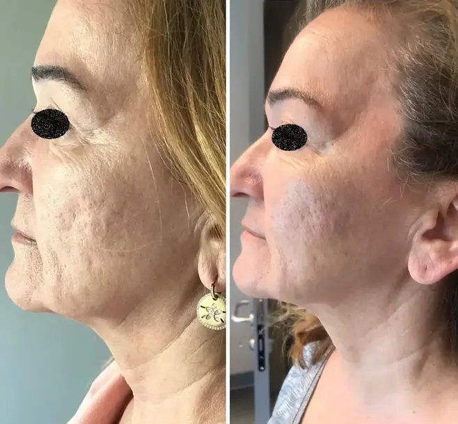 Morpheus8 Fractional Microneedling Before After