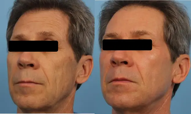 CO2 Fractional  Laser Before and After